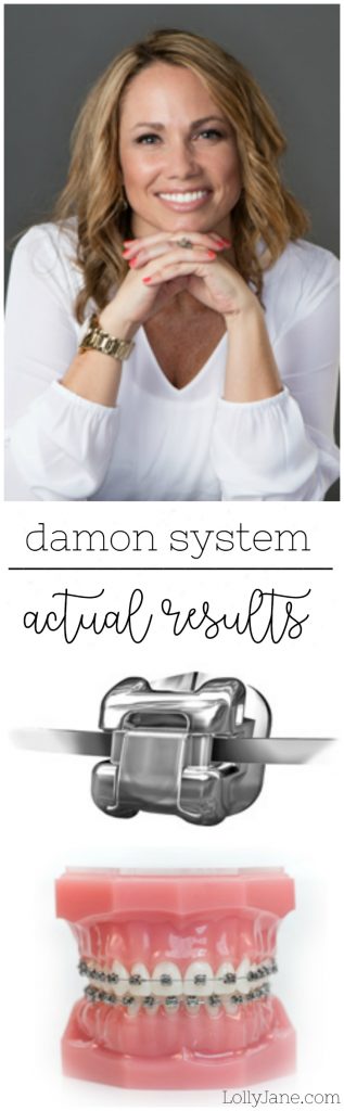 Check out these results of the Damon System! We love the self-ligating brackets to shorten your braces experience and make them more comfortable!