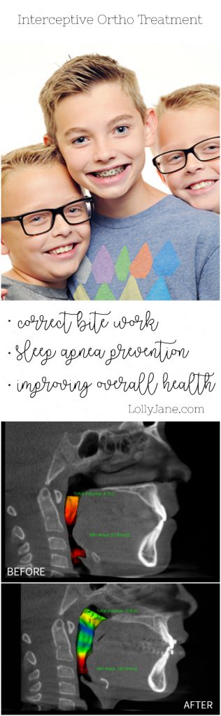 Learn more about interceptive treatment for minors and braces. We love the Damon System which can prevent crossbites, underbites, treat sleep apnea and improve overall health. WOW!